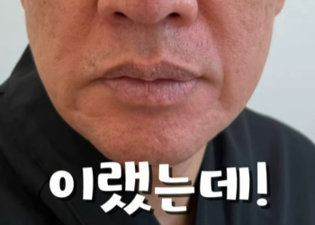 안면거상하면 진짜 이렇게 되나요? (:네)