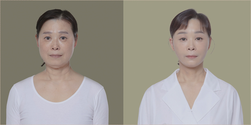 スンプラス 手術ビフォーアフター