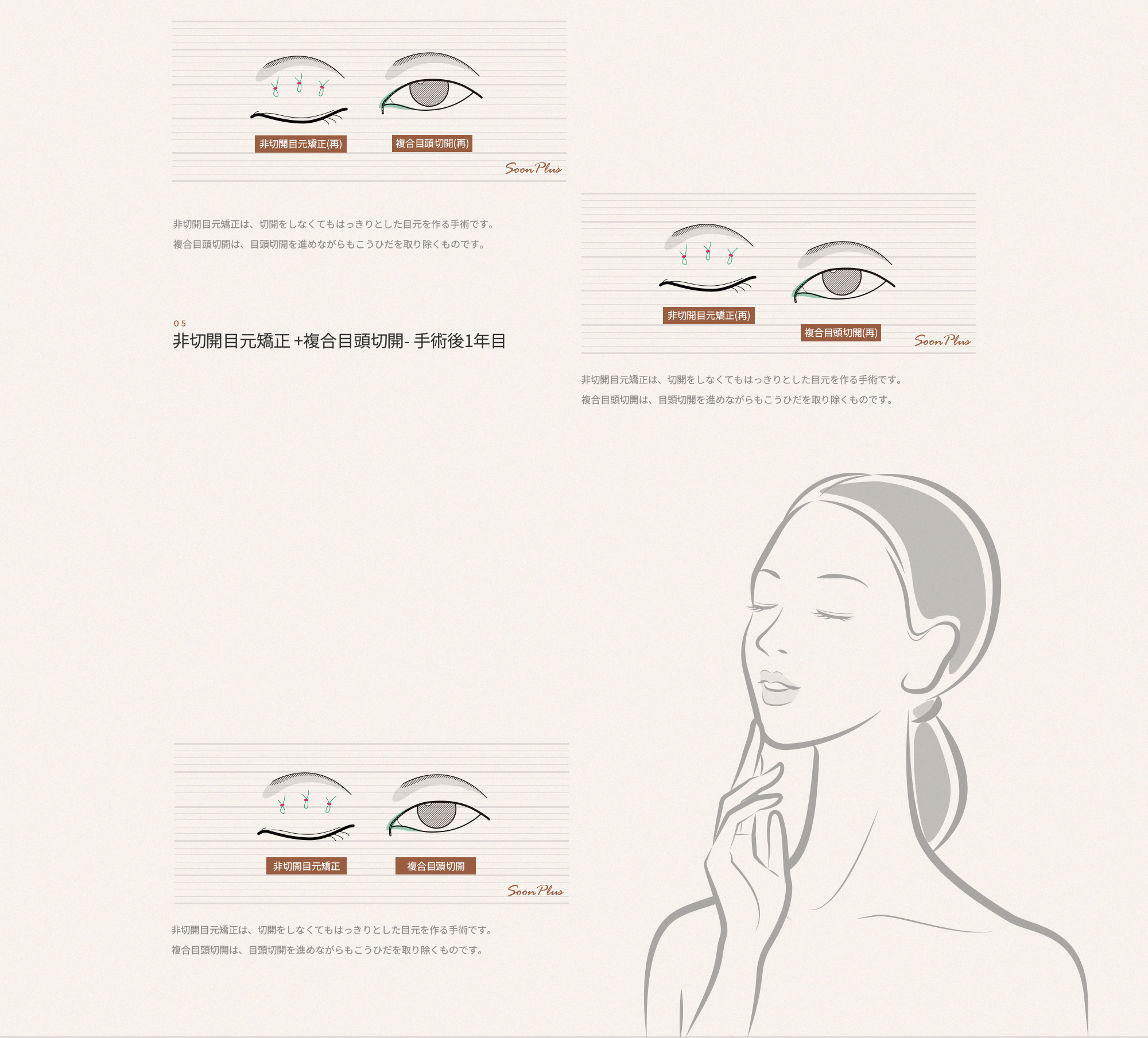 비절기 눈매교정은 절개를 진행하지 않고도 또렷한 눈매를 만드는 수술입니다.