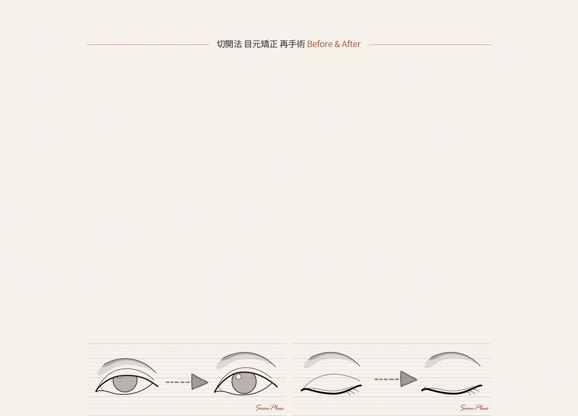 절개법 눈매교정 재수술 Before & After