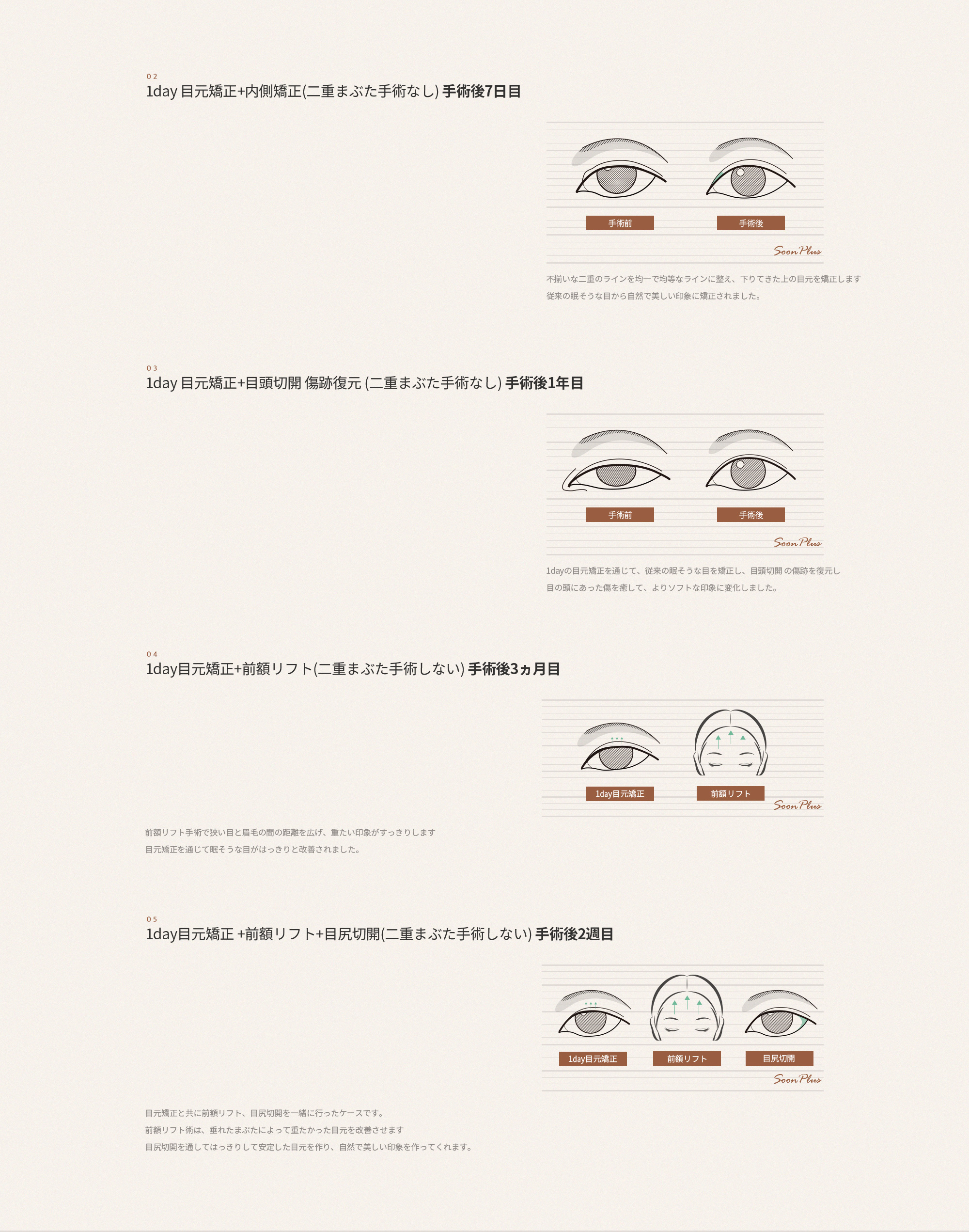 다양한 형태의 졸린 눈을 내가 원하는 눈매로 맞춤 교정이 가능합니다.