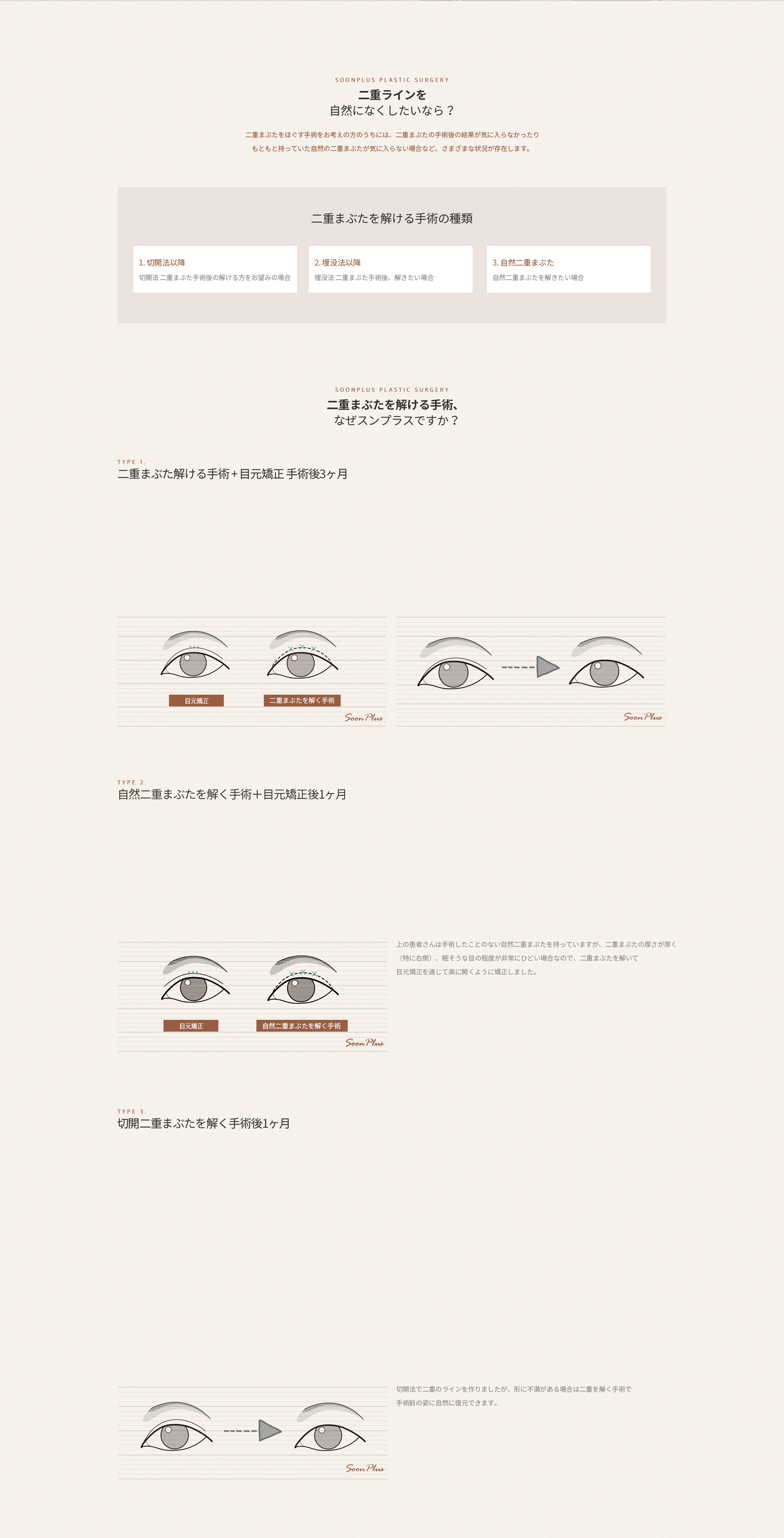 쌍꺼풀 푸는 수술
