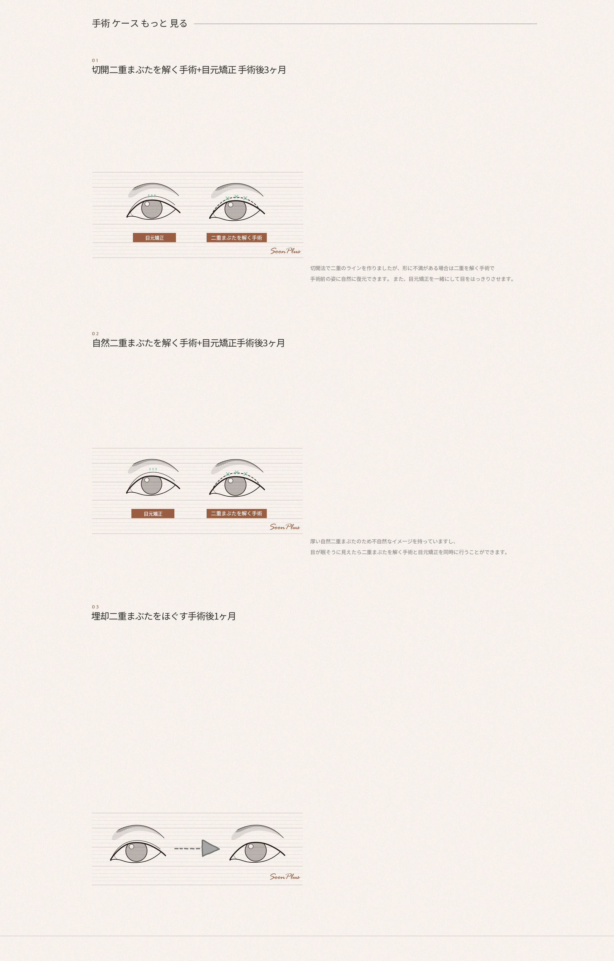 쌍꺼풀 푸는 수술
