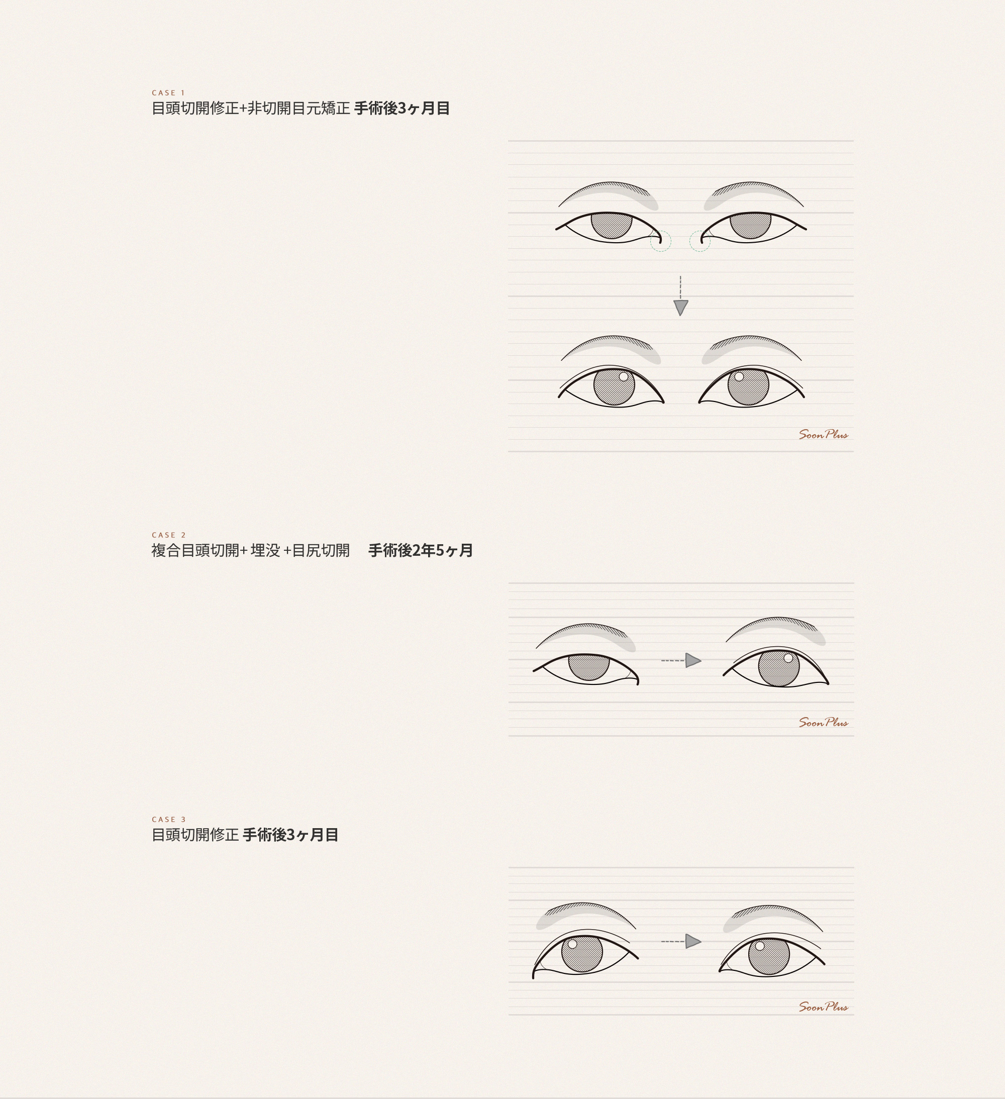 sub_1
