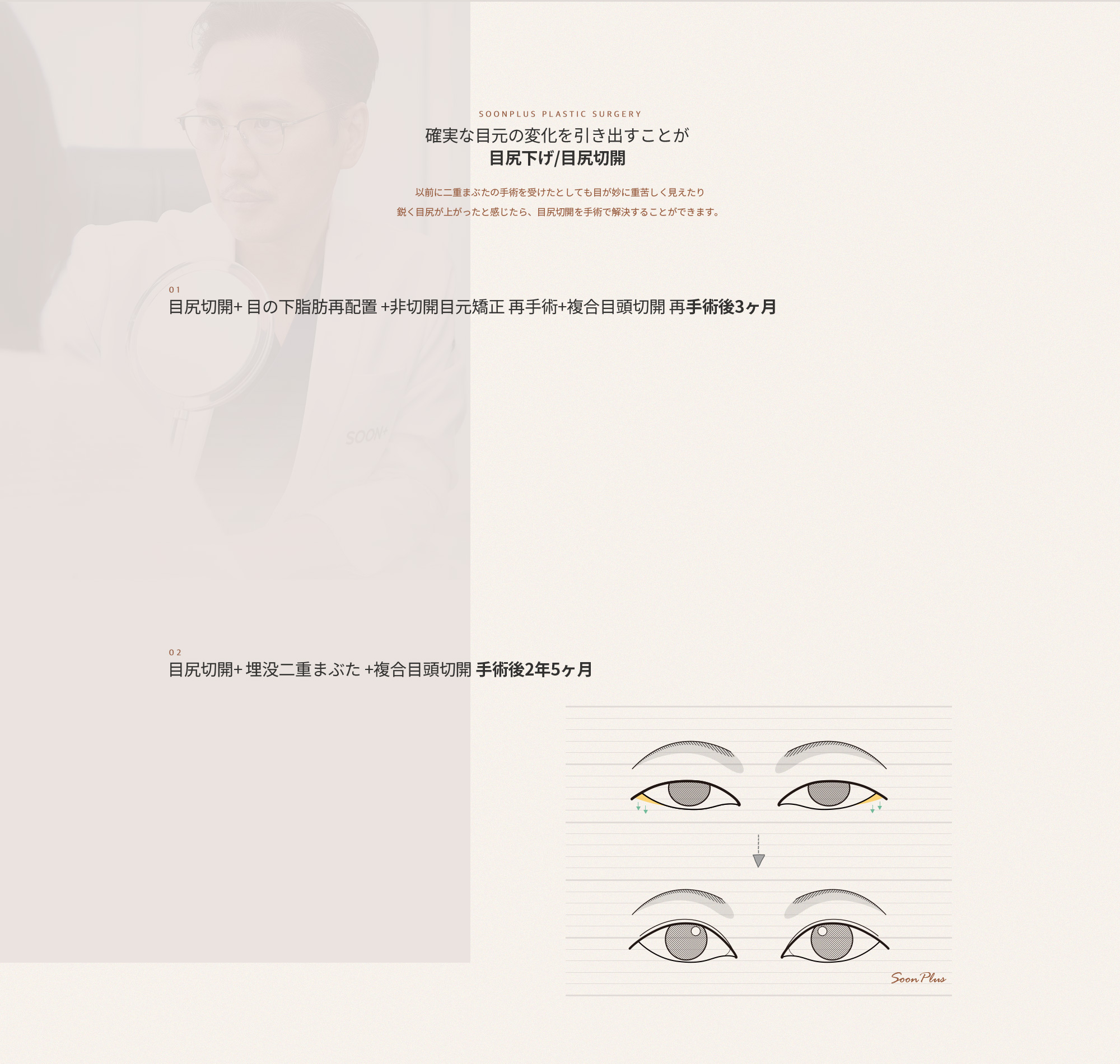 확실한 눈매의 변화를 이끌어내는 눈꼬리내리기/뒤트임