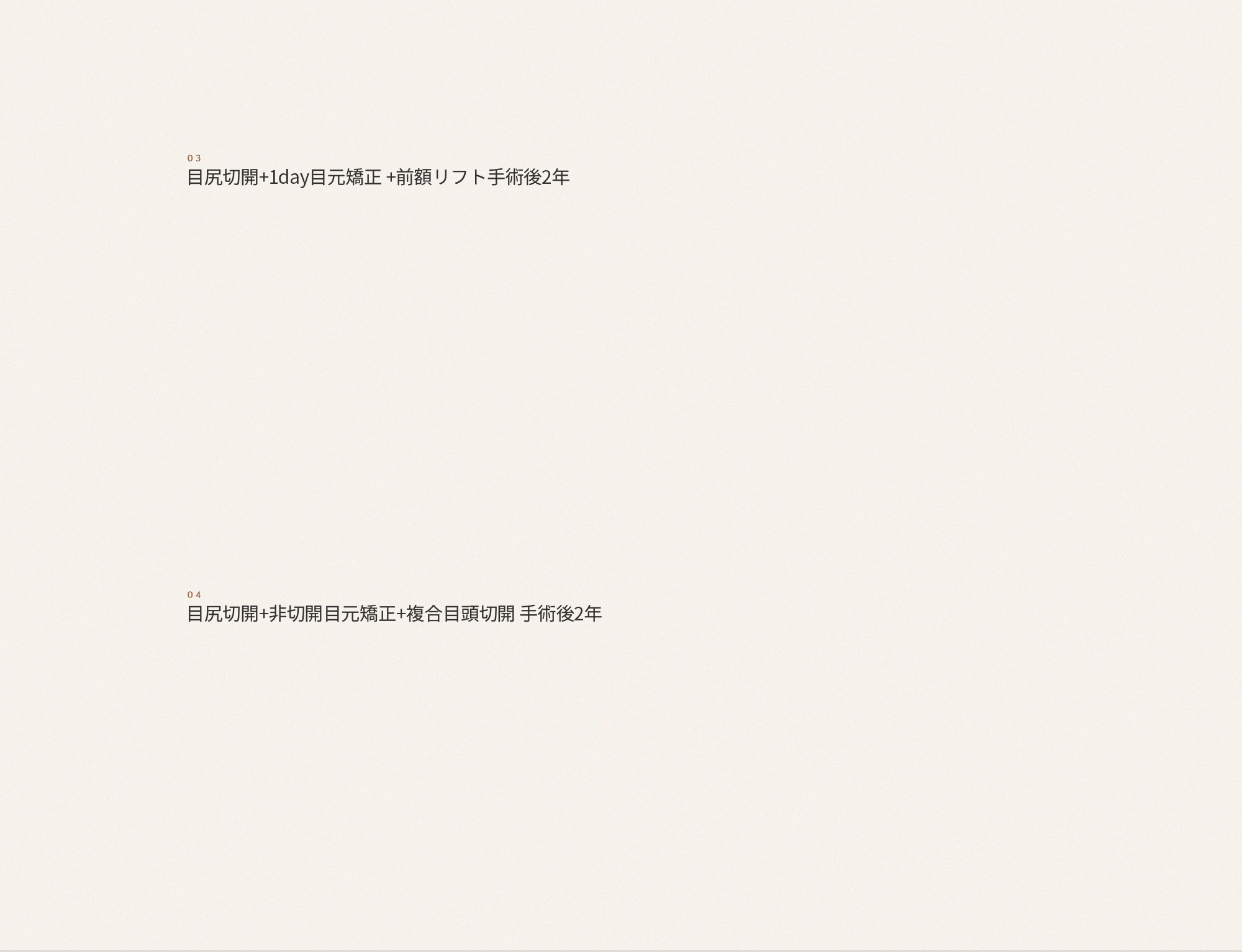 기존에 쌍꺼풀 수술을 받았더라도 눈이 묘하게 답답해보이거나 사납게 눈꼬리가 올라갔다고 느껴진다면 뒤트임을 수술을 통해 해결 할 수 있습니다.