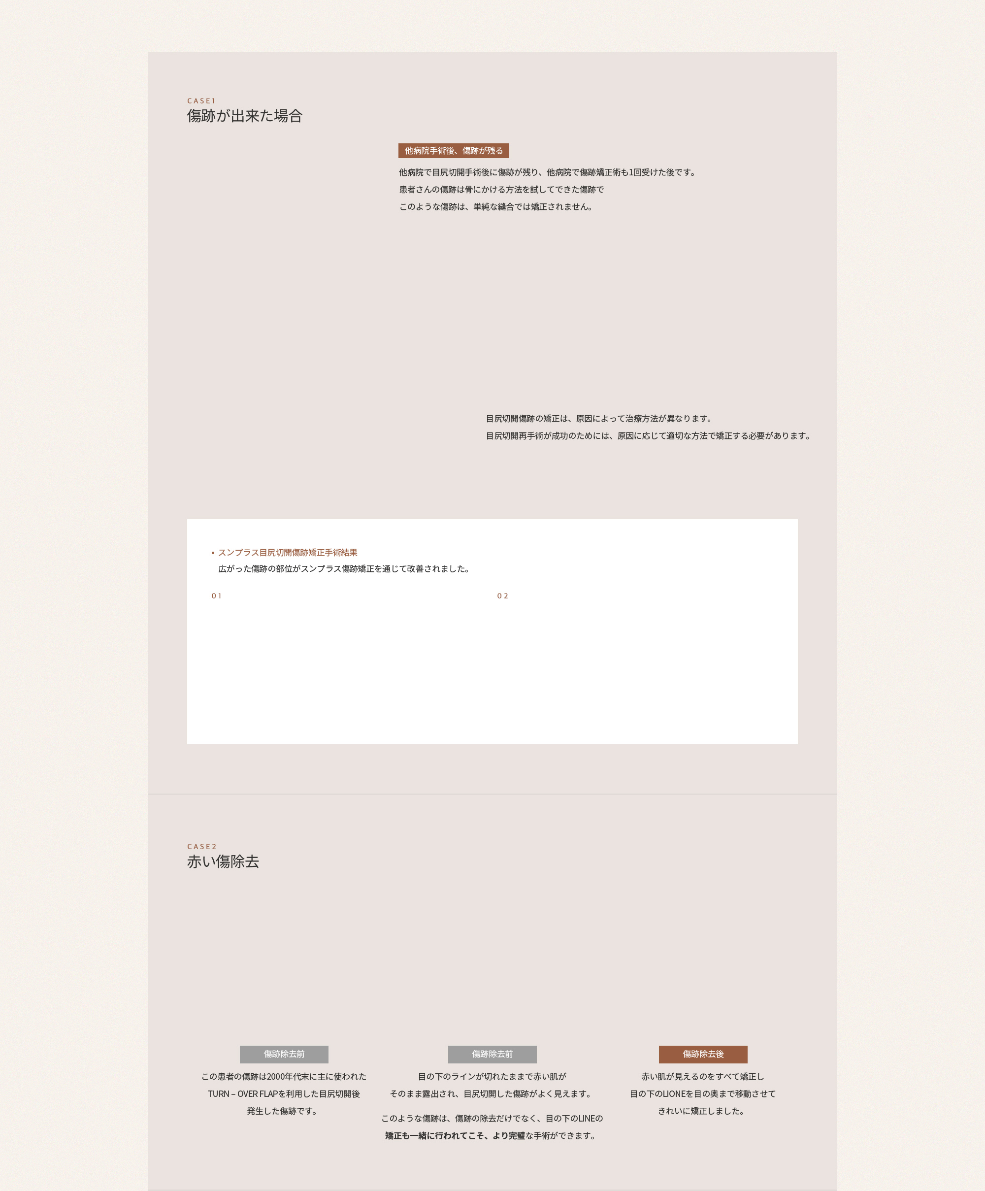 뒤트임 재수술은 이미 흉터가 생긴 부위를 다시 재수술하는 것이기 때문에 어설프게 수술했다간 새로운 흉터가 발생할 수 있으므로 의료진의 실력이 무엇보다 중요합니다.