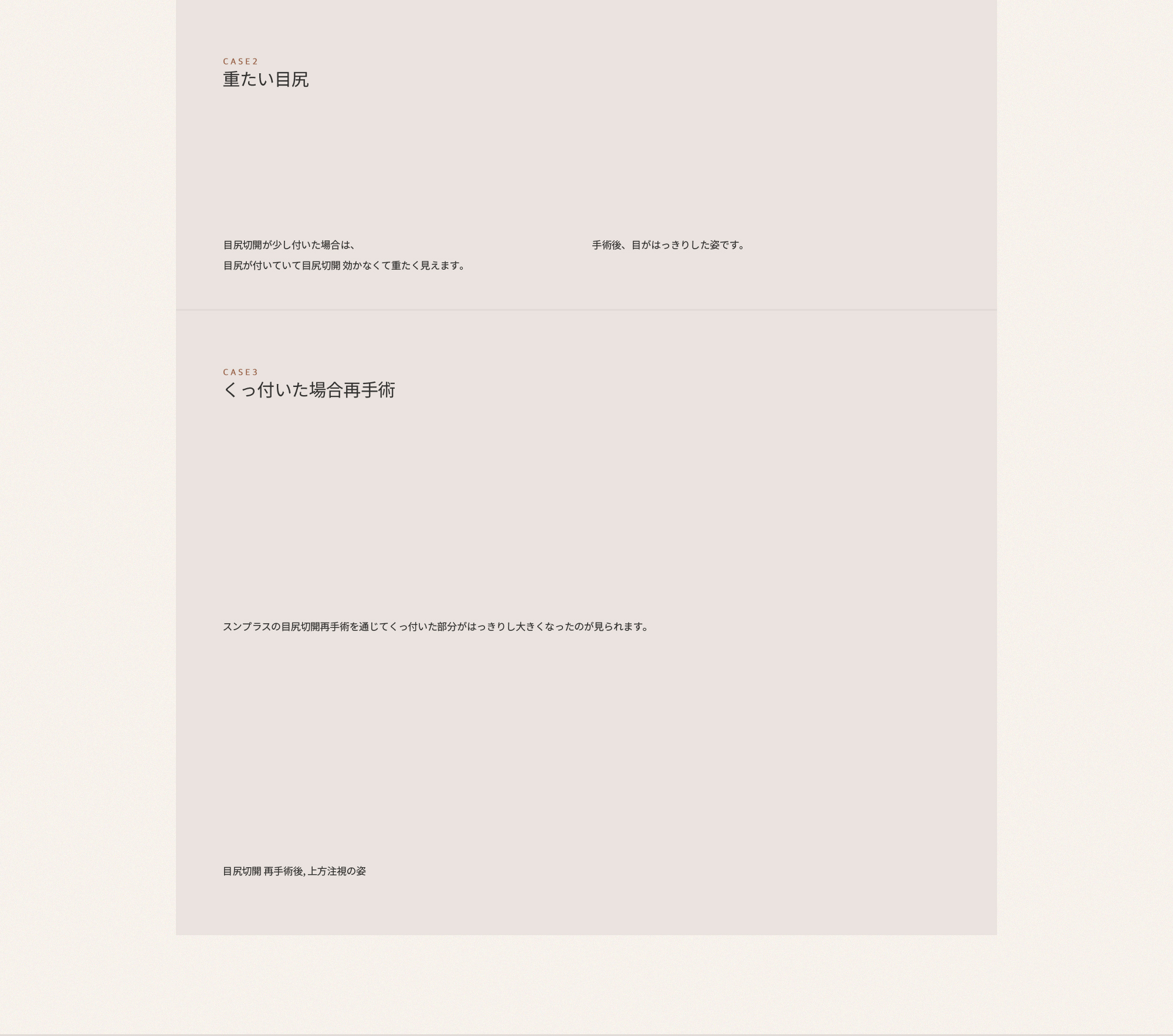 뒤트임이 붙는다는 건 뒤트임 수술을 할 필요가 없었다는 것이나 마찬가지입니다.