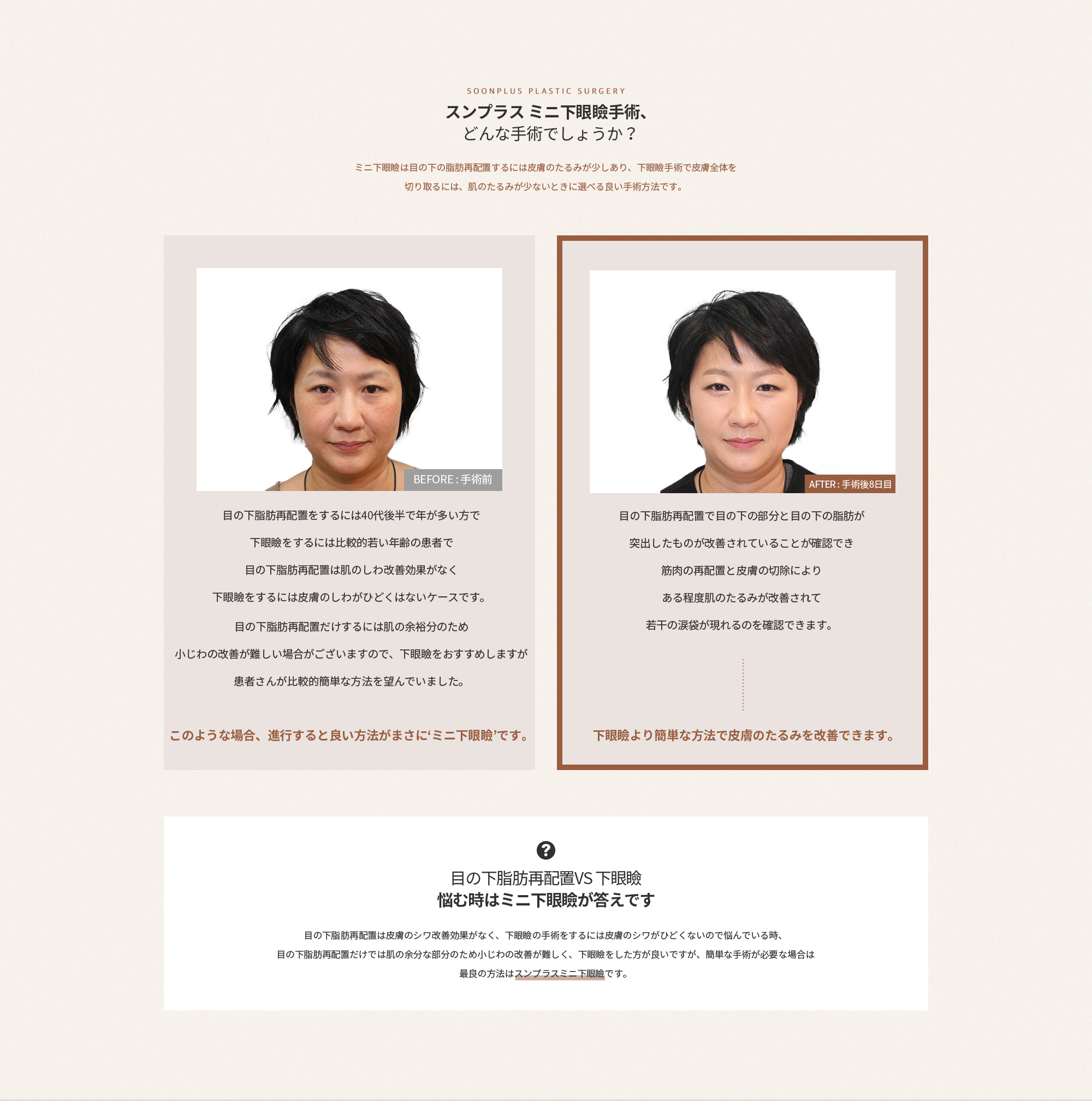 눈밑지방재배치 VS 하안검 고민될 땐 미니하안검이 답입니다