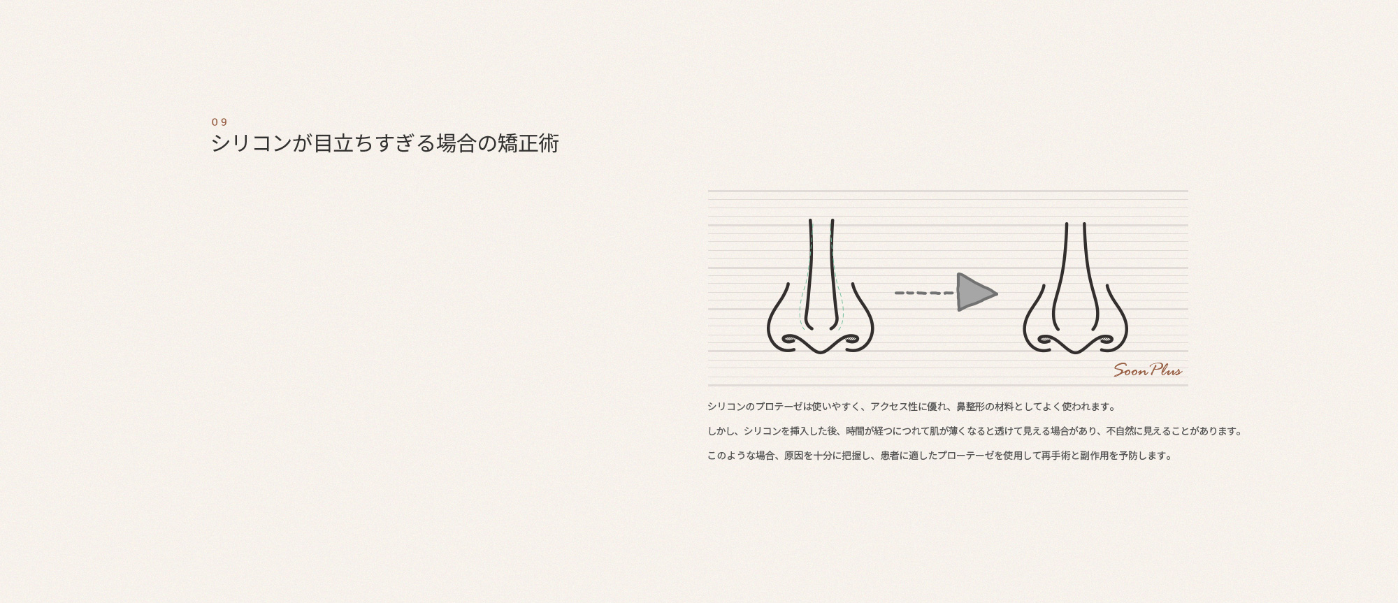 코 재수술