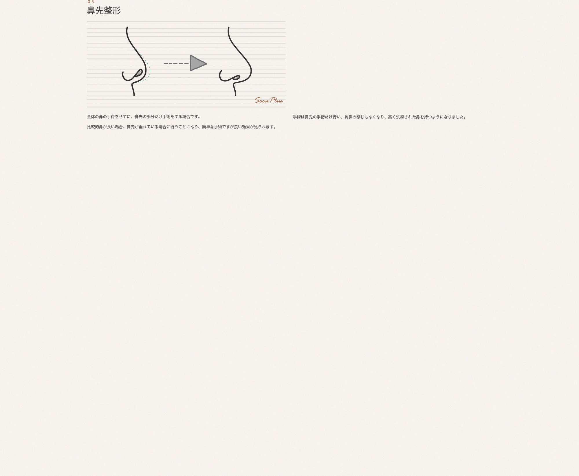 05 코끝 성형